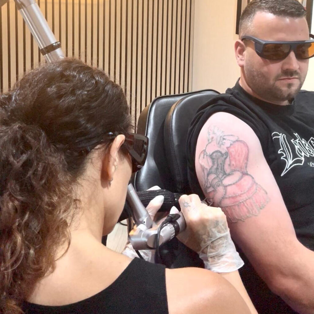Picosecond laser tattoo removal treatment in progress